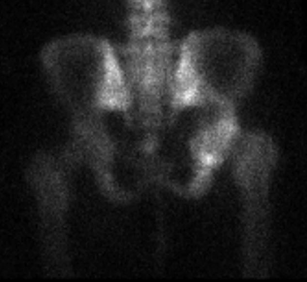 Figure 3 for case Primary angiosarcoma of bone